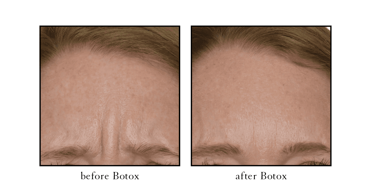 Botox before and after forehead lines Winter Park, FL Botox before and after forehead lines Winter Park, FL