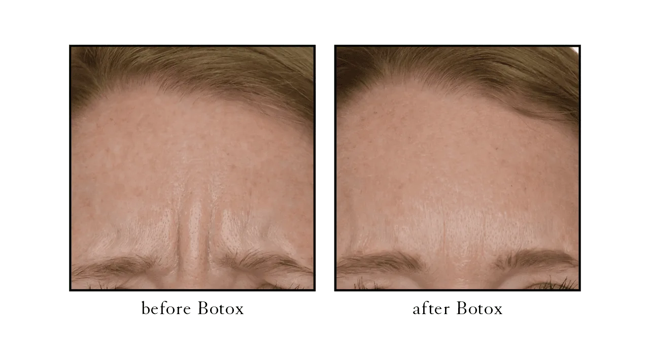 Botox before and after forehead lines Winter Park, FL