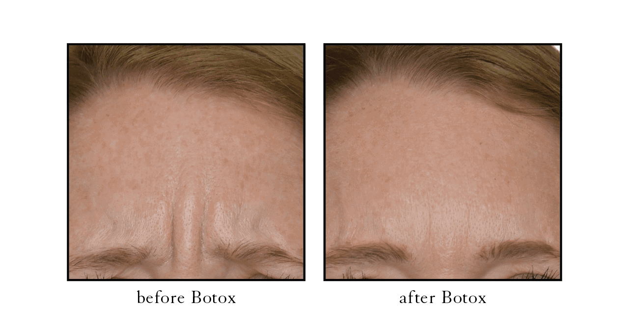 Before and after Botox Vero Beach Before and after Botox Vero Beach