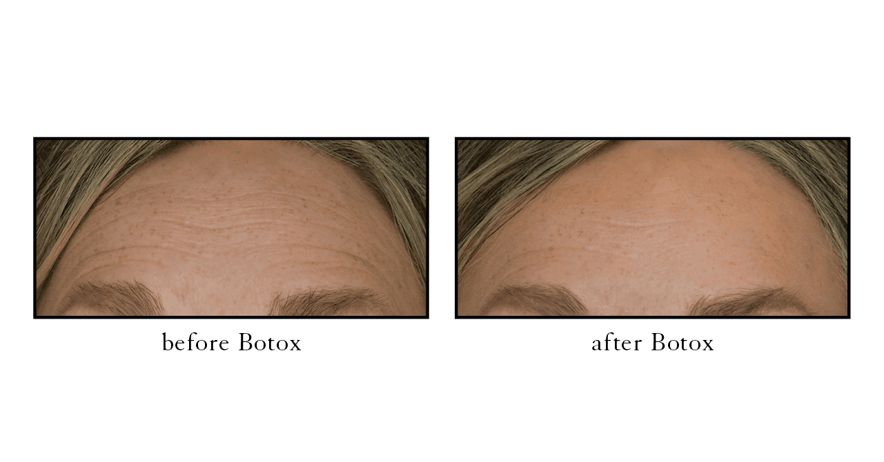 Botox before and after Lake Mary Botox before and after Lake Mary