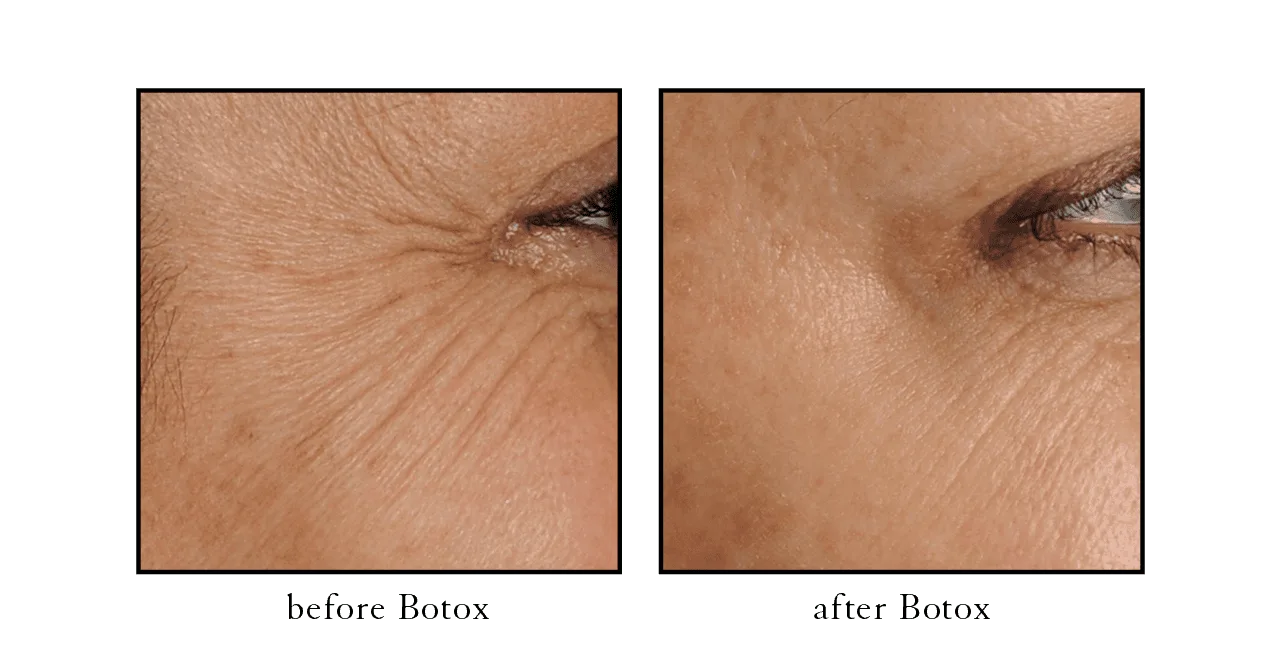 crows feet before and after Winter Park, FL