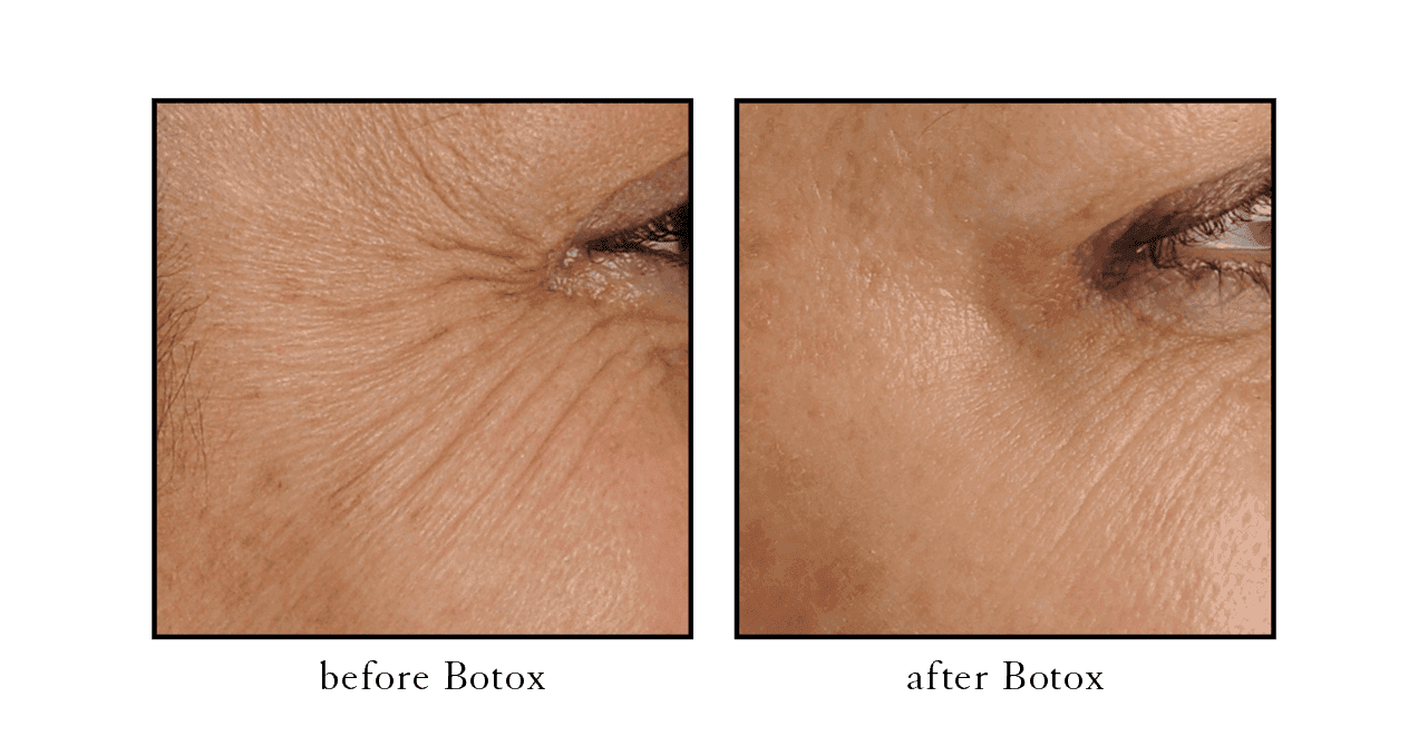 Crows Feet before and after Lake Mary Crows Feet before and after Lake Mary