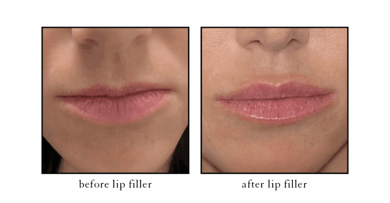 Real patient lip filler before and after in East Lansing at CSLC