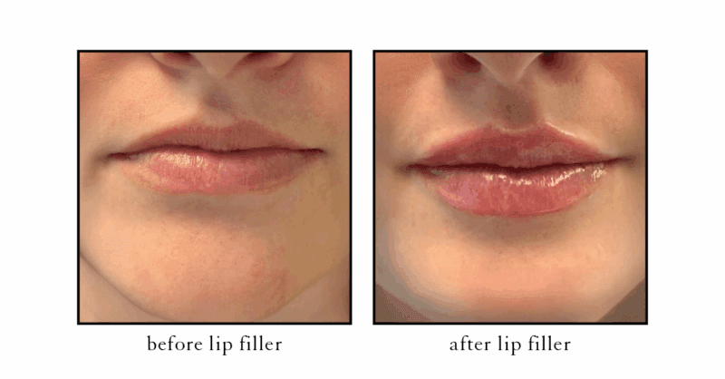 Subtle, natural lip filler results for patients from Okemos and Haslett at CSLC East Lansing.