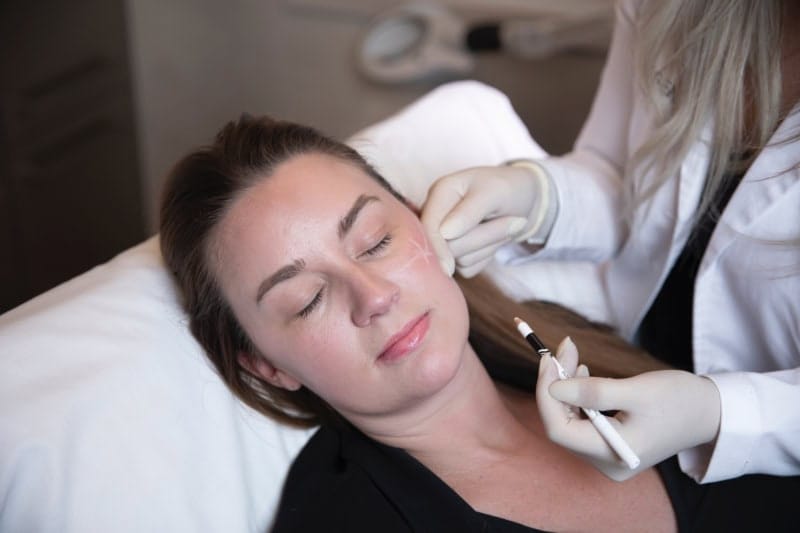 Sculptra treatment for natural lift in Naples FL
