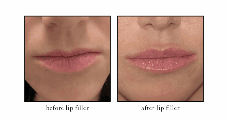 Before and after lip filler at Cosmetic Skin and Laser Center