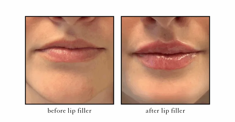 Before and after natural lip filler at CSLC