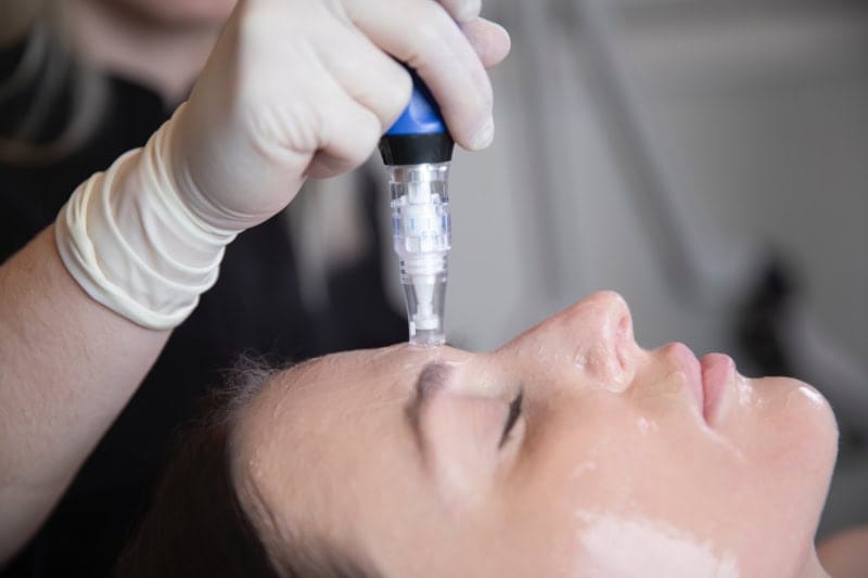 Microneedling treatment with PRP/PRF at Cosmetic Skin & Laser Center