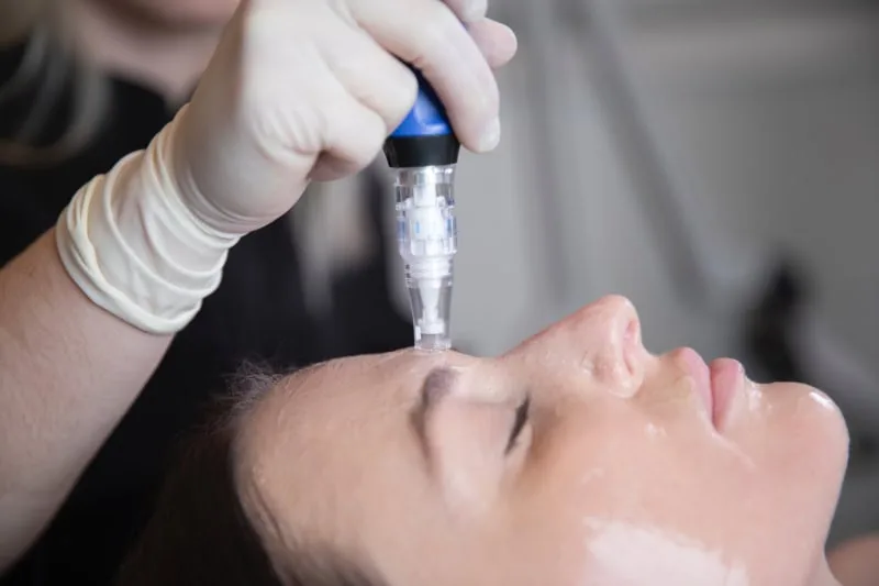 Skinpen Microneedling treatment at Cosmetic Skin and Laser Center