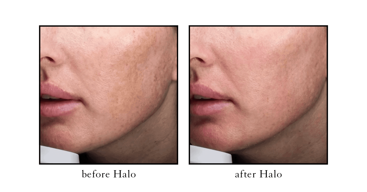 halo_CSLC_before_after Halo before and after at Cosmetic Skin & Laser Center
