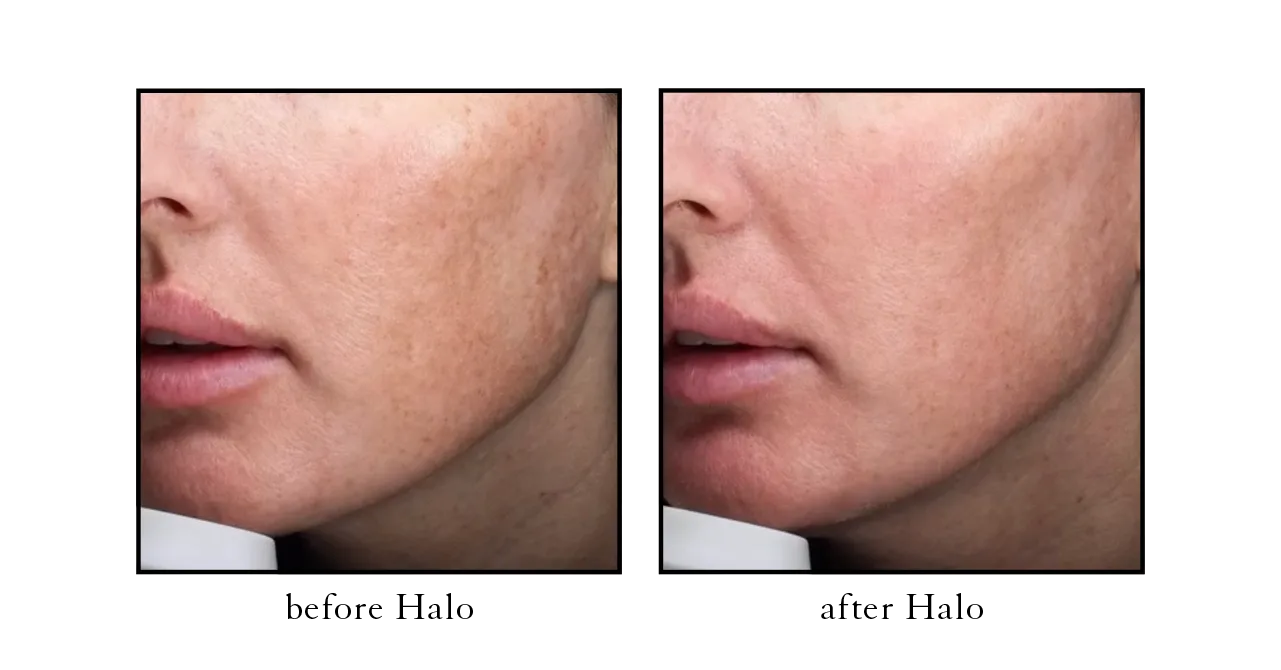 Halo before and after at Cosmetic Skin & Laser Center