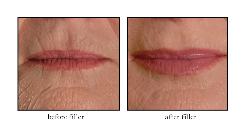 Filler around mouth results at CSLC