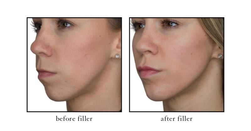 Jawline filler results at Cosmetic Skin & Laser Center