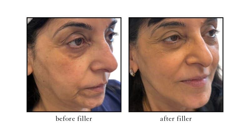 Mid face filler before and after at CSLC