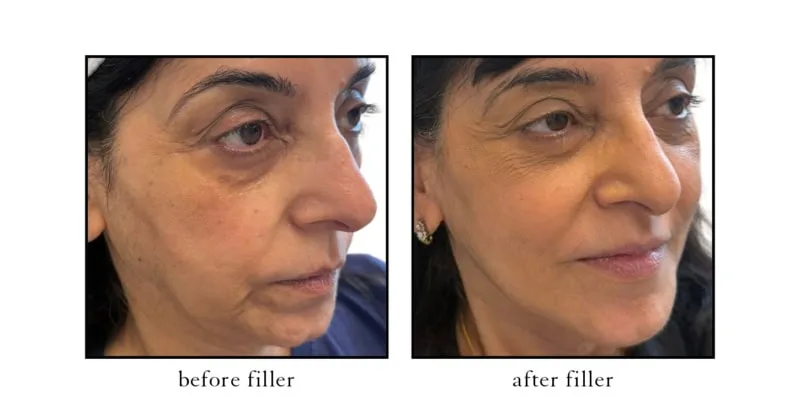 Mid face filler before and after at CSLC