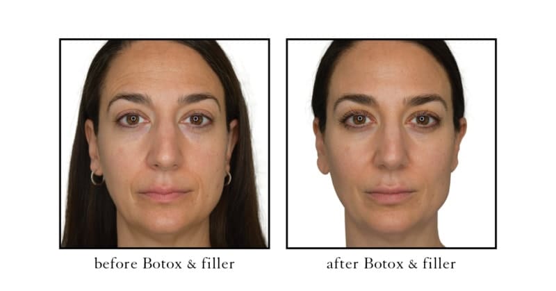 Mid face filler before and after at Cosmetic Skin & Laser Center