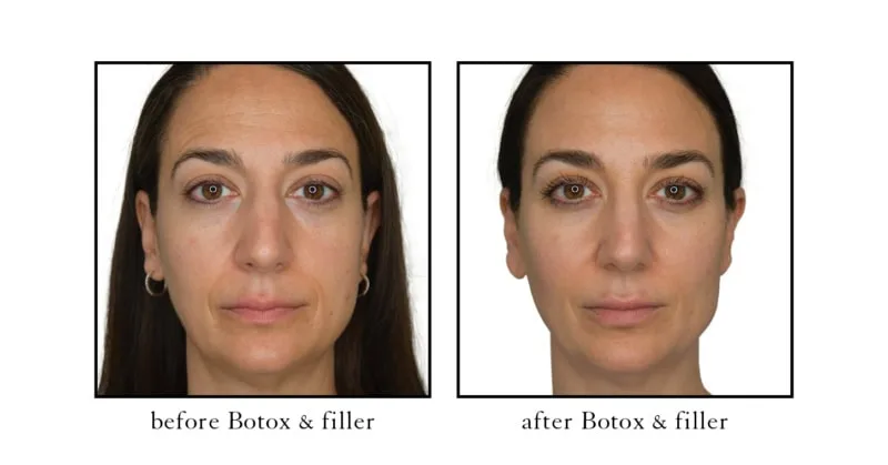 Mid face filler before and after at Cosmetic Skin & Laser Center