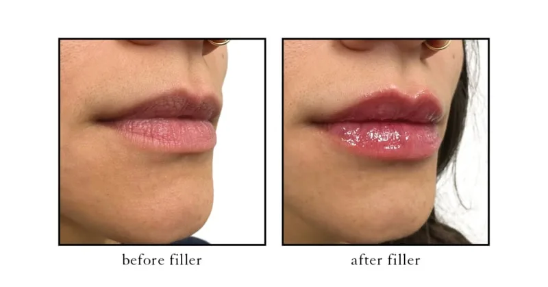 Natural lip filler results at CSLC