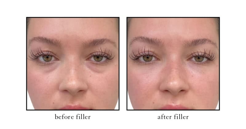 Under eye filler before and after at CSLC