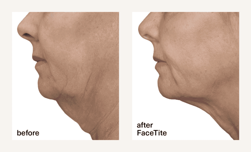 Before and after FaceTite treatment at CSLC showing visible jawline and neck contour improvement in a female patient.