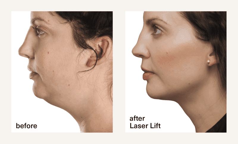 Before and after Laser Lift treatment at CSLC showing defined jawline and reduced submental fullness in a female patient.