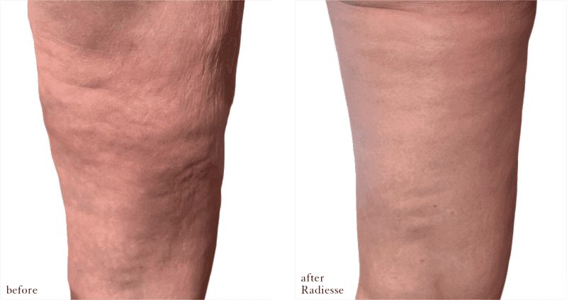 Before and after radiesse legs at Cosmetic Skin & Laser Center