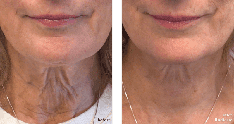 Before and after radiesse neck at Cosmetic Skin & Laser Center